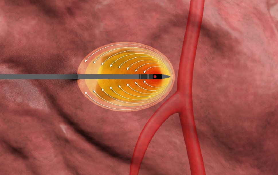 Neuwave microwave ablation system ethicon