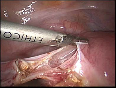 Ethicon supports complex Gynecologic Surgeries