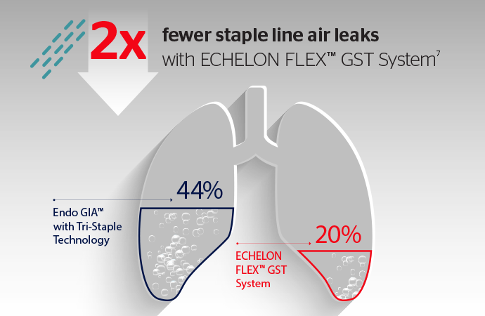 Physiologic lung model reveals fewer air leaks⁷