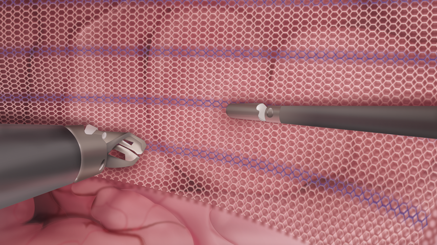 LAP Inguinal | Ethicon